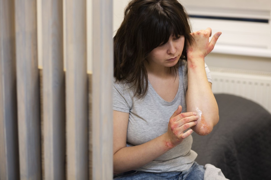 Женщина с псориазом на руках