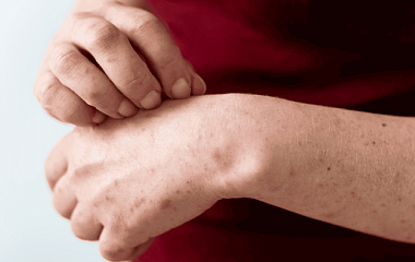 Как отличить экзему от псориаза