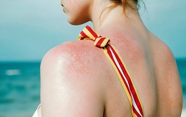 Причины возникновения псориаза