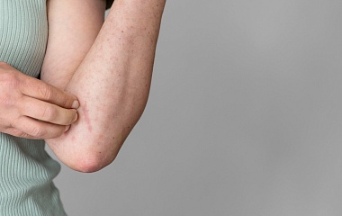 От чего обостряется атопический дерматит