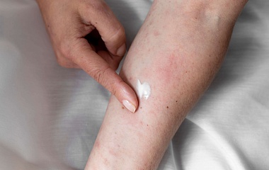 Чем опасен псориаз