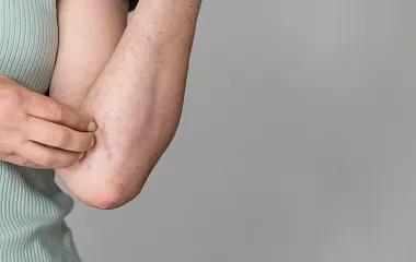 От чего обостряется атопический дерматит